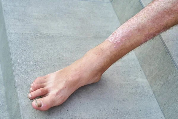 Severe Psoriasis Man Leg Close — Stock Photo, Image