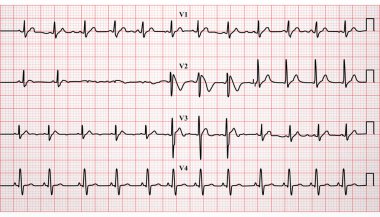 Elektrokardiyogram, EKG, vektör biçiminde kalp atışı