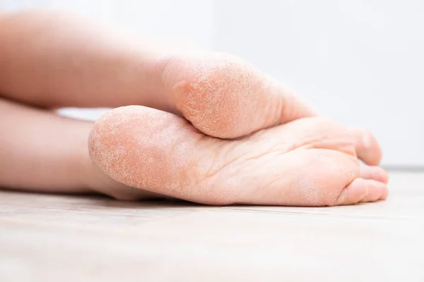Die trockene Haut an den Füßen ist rissig. Behandlungskonzept mit feuchtigkeitsspendenden Cremes und Peeling zur Heilung von Wunden und Schmerzen beim Gehen. Dehydrierte Haut auf den Fersen weiblicher Füße lizenzfreie Stockfotos