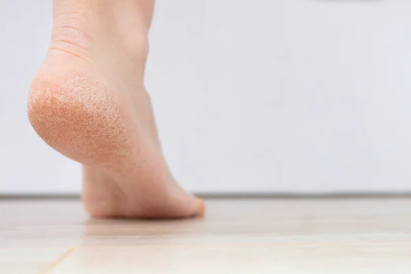 Topuktaki kuru deri çatlamış. Nemlendirici kremler ile tedavi konsepti ve yürürken yaraları iyileştirmek için deri dökülmesi ve acı. Kadın ayağının topuklarında kurumuş deri. Yüksek kalite fotoğraf