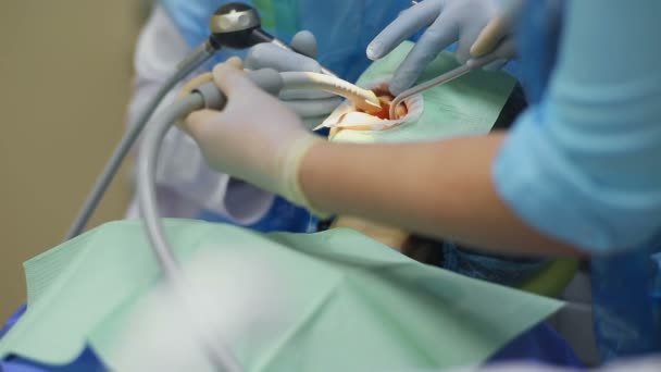 Dentista opera dientes de mujer paciente con equipo especial — Vídeo de stock