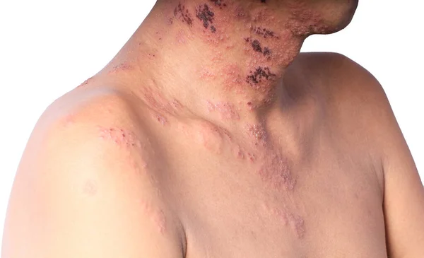 Herpes Zoster Culebrilla Zoster Síntoma Está Infectado Por Virus Varicella — Foto de Stock