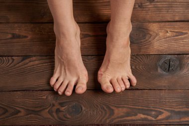 Kadın bacaklarındaki Hllux Valgus ahşap arka plana yaklaşır. Ayak eklem deformasyonu. İnsan vücudunda sağlık ve ilaç sorunu