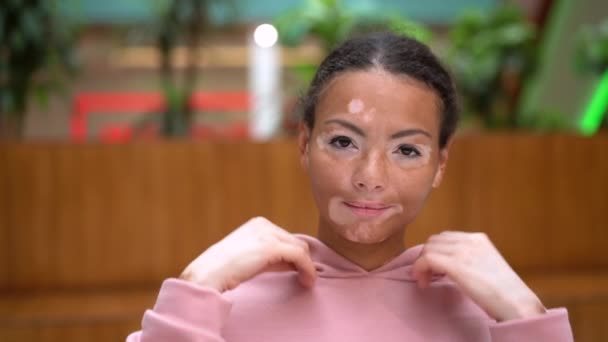 Afrika hitam Amerika wanita dengan masalah kulit vitiligo pigmentasi di dalam ruangan berpakaian hoodie merah muda — Stok Video