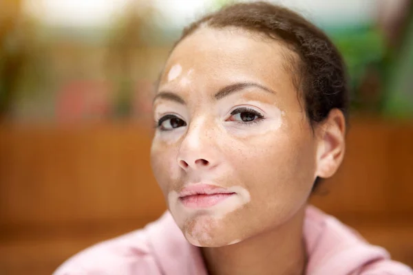 Black african american woman with vitiligo pigmentation skin problem indoor dressed pink hoodie close up portrait pensive black female thinking about