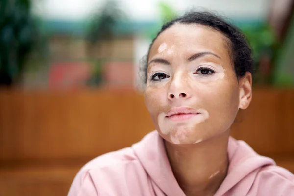 Black african american woman with vitiligo pigmentation skin problem indoor dressed pink hoodie close up portrait pensive black female thinking about