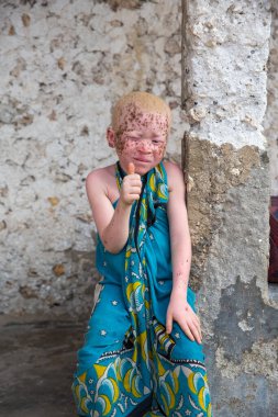Zanzibar, Tanzanya, 22 Ocak 2021: Afrikalı albino çocuk kulübesinin merdivenlerinde oturuyor