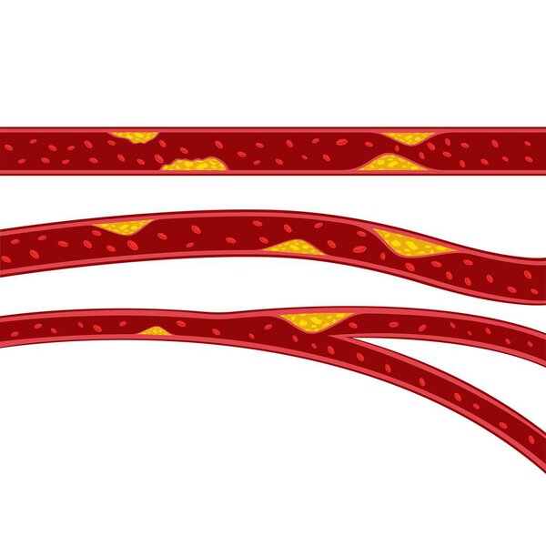 vector of cholesterol plaque illustratrion design 