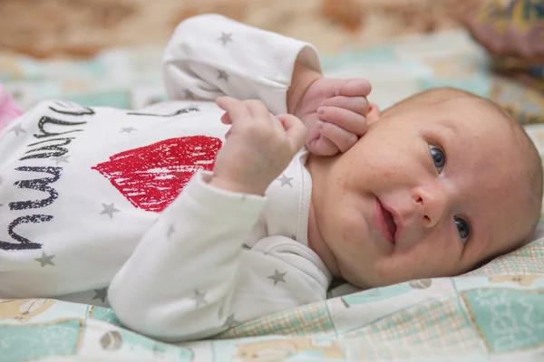 Гормональная сыпь у новорожденных — стоковое фото
