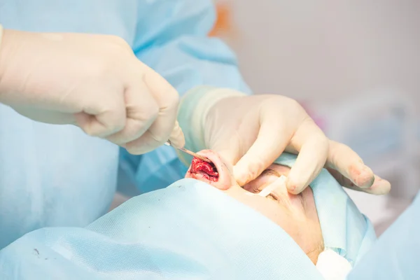 Surgery to change the shape of the nose — Stock Photo, Image