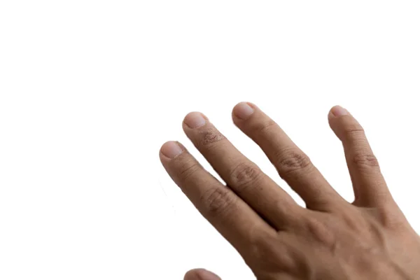 Jeukende huiduitslag eczeem op vrouw huid vinger — Stockfoto