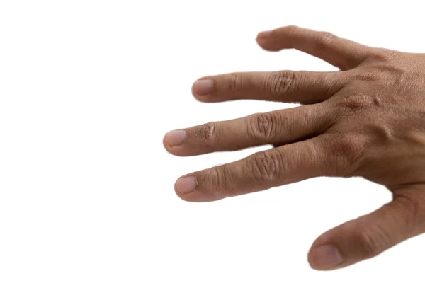 Jeukende huiduitslag eczeem op vrouw huid vinger — Stockfoto