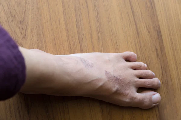 Rash eczema on woman skin foot — Stock Photo, Image