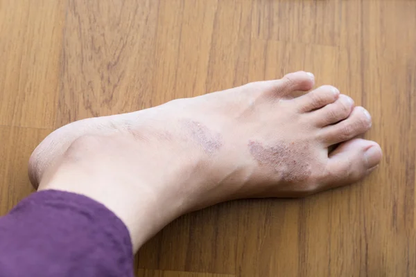 Rash eczema on woman skin foot — Stock Photo, Image