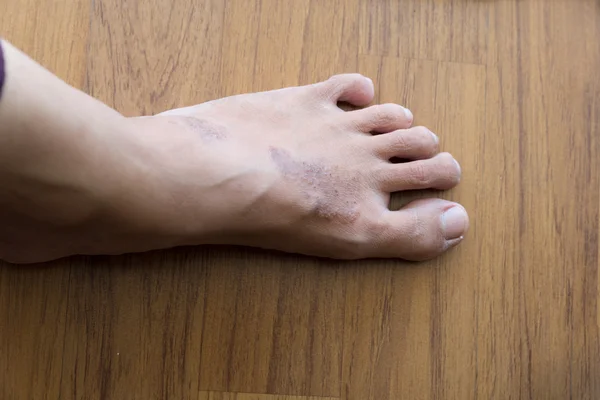 Сыпь экзема на коже женщины ноги — стоковое фото