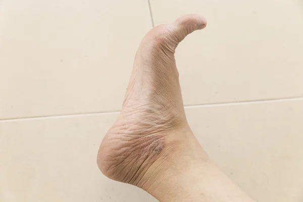 Rash eczema on woman skin foot — Stock Photo, Image