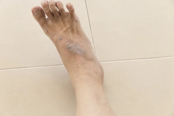 Erupção cutânea eczema no pé da pele da mulher — Fotografia de Stock