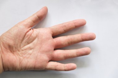 wasp sting şişmiş eli