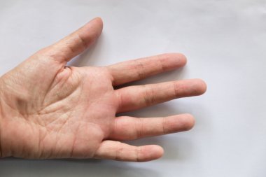wasp sting şişmiş eli