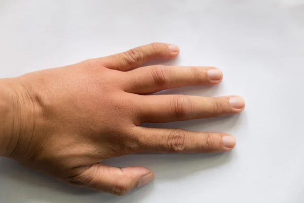 Swollen hand from wasp sting — Stock Photo, Image