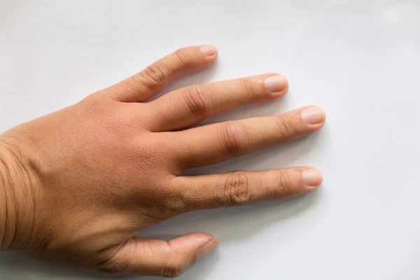 Swollen hand from wasp sting — Stock Photo, Image
