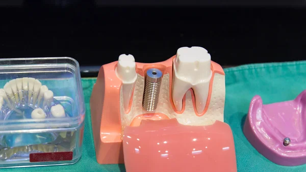 El modelo de dientes de subestructura del implante — Foto de Stock