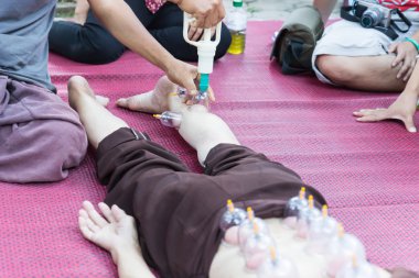 bacak ve arka cilt vakum, Çin alternatif tıp 