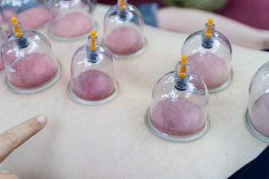 arka cilt vakum, Çin alternatif tıp 