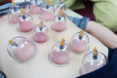 arka cilt vakum, Çin alternatif tıp 
