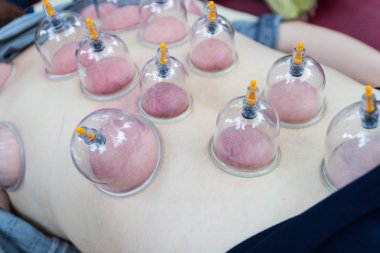 arka cilt vakum, Çin alternatif tıp 