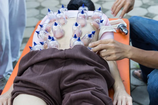 Back skin vacuum, la médecine alternative chinoise — Photo