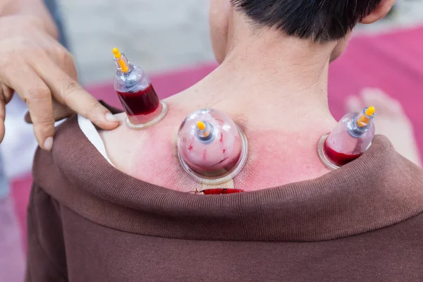 Back skin vacuum and Phlebotomy, the chinese alternative medicin — Stock Photo, Image