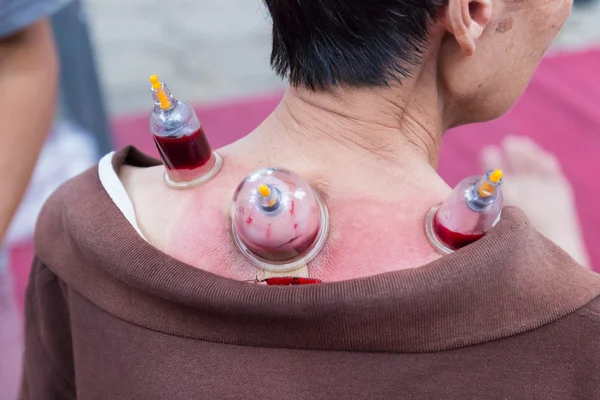 Rückenhautvakuum und Phlebotomie, die chinesische Alternativmedizin — Stockfoto