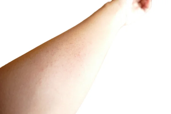 Itchy rash on arm isolated on white background — Stock Photo, Image