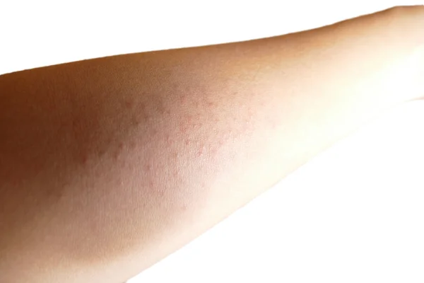 Itchy rash on arm isolated on white background — Stock Photo, Image