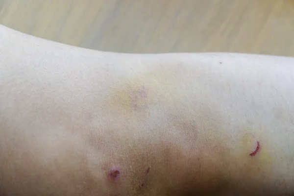 Contusão de nódoas negras no joelho — Fotografia de Stock