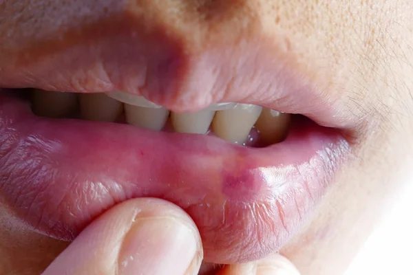Bruise at the lip — Stock Photo, Image