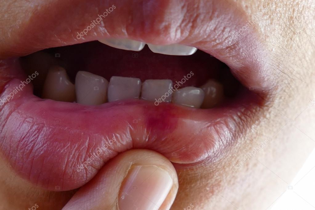 Bruise at the lip — Stock Photo © psisaa 86002266