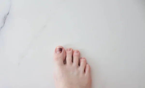Nehty Nohou Poškozené Hematomem Oddělit Hřebík Fouknout Hřebíku Narůstající Nehet — Stock fotografie