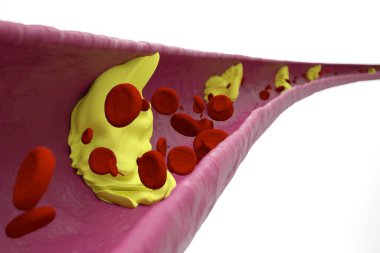 Dayanışma, Tıkanma, Şişmanlık, Boyut, Yağ, Kavram, Tıkanma, Kardiyovasküler, Tehlike, Koroner, Atheromatöz, Mikroskop, Çalışma, Taşıma, Kırmızı Kan Hücresi Sayımı, Analiz, İnsan Vücudu, Kan Tipi, Memeliler, Karbon Monoksit, Oksijen Taşımacılığı, Hemoglobin Taşımacılığı