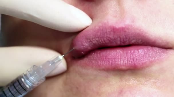 Inyección Relleno Ácido Hialurónico Aumento Labial Superior Procedimiento Real Una — Vídeo de stock