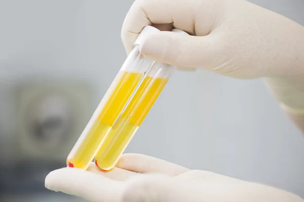 Blood plasma in test tubes for plasmalifting — Stock Photo, Image