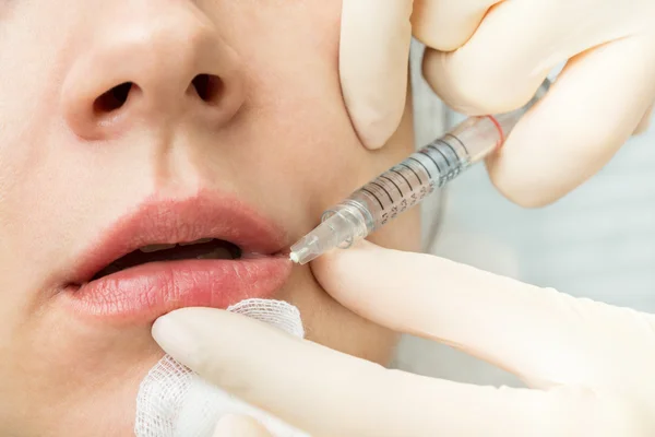 Procedure is the injection of hyaluronic acid into the lower lip — Stock Photo, Image