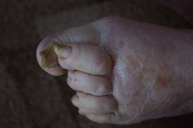 Eklem iltihabından sakat ayak parmakları olan yaşlı bir adamın bacağı.