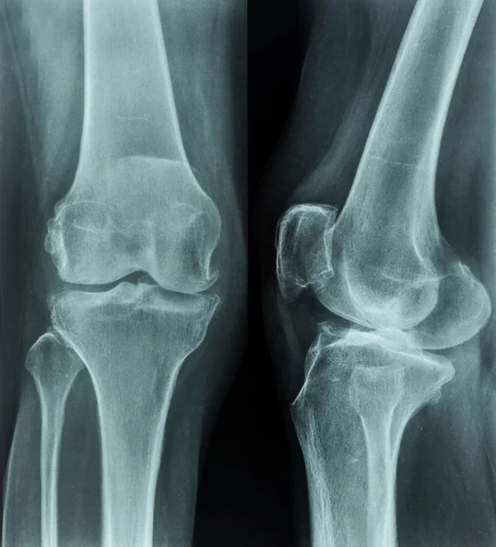 рентгеновский снимок стопы в норме. поперечное плоскостопие рентген. как выглядит рентген ноги. перелом сесамовидной кости 1 пальца стопы. малоберцовая кость рентген.