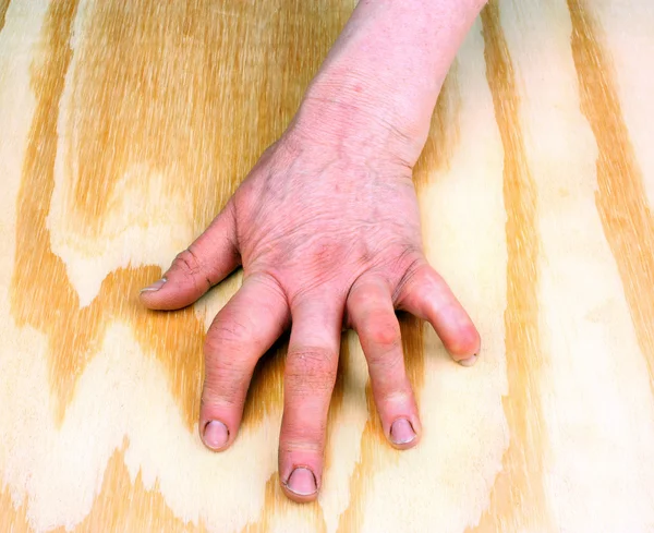 Revmatoidní artritida ruka — Stock fotografie