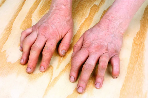 Revmatoidní artritida ruka — Stock fotografie