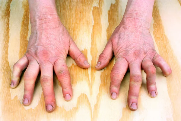 类风湿关节炎的手 — 图库照片
