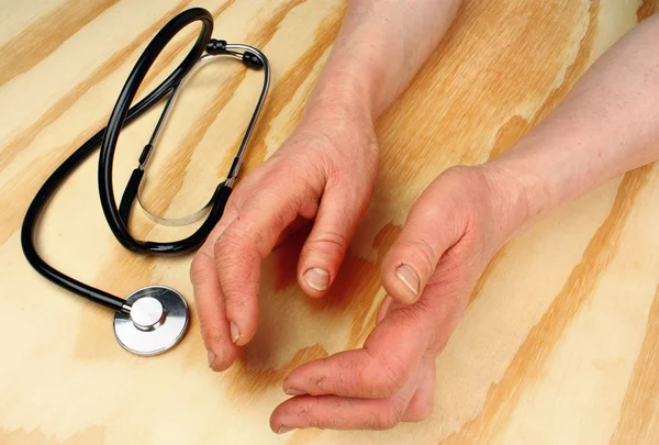 Arthritis of the hands — Stock Photo, Image