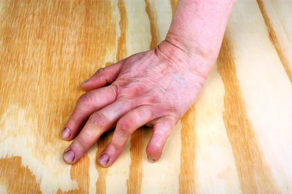 Артрит руки — стоковое фото